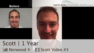 Hair Growth  Hair Transplant Before and After  1 Year Result Scott [upl. by Teria]