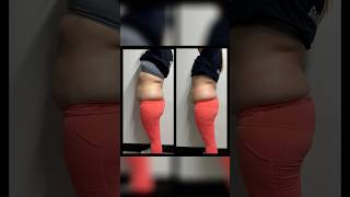 Results of cryoslimming cryotherapy cryoslimming cryotherapist [upl. by Clio]