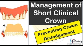 Short Clinical Crown Management Insufficient Height Improving the Retention and Resistance Form [upl. by Shanie238]