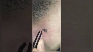 ingrown hair removal 😌 ENJOY [upl. by Ahsoyem]