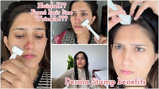 Derma stamp benefits for hair fall amp aging  Hairfall guide by Natasha waqas [upl. by Steinman669]