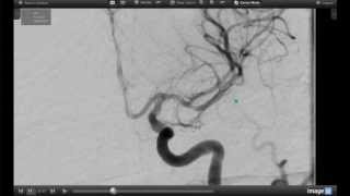 How Endovascular Stroke Treatment Works [upl. by Eibmab]