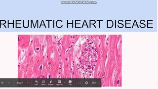 Rheumatic Heart Disease Pathogenesis Morphology Clinical features [upl. by Bathilda]