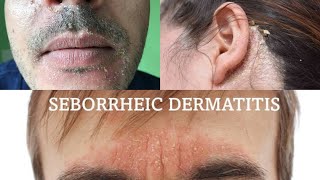 Seborrheic dermatitis  treatment health [upl. by Godard356]