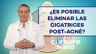 ¿Es posible eliminar las cicatrices postacné [upl. by Afihtan]