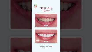 GiO Healthy Veneer [upl. by Ahsiym]