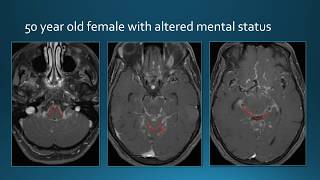 Meningeal Enhancement [upl. by Alleirbag]