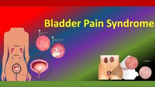 Bladder Pain Syndrome RCOG Guideline [upl. by Fi]