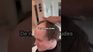 Comment èviter la calvitie calvitie haircut hair pertedecheveux hairtransformation glowup [upl. by Apeed]