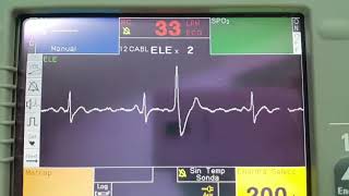 Extrasistole ventricular electrocardiograma 😼😼 [upl. by Yared]