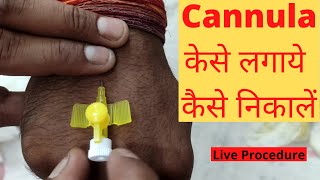 Cannula Kaise Lagate Hain  Kaise Nikale  Cannula Insertion Technique  Cannula Types  Hindi [upl. by Isyad]