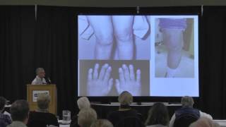 Inflammatory Arthritis Types and Treatments [upl. by Lamp535]