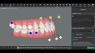 Class III Invisalign [upl. by Langer776]