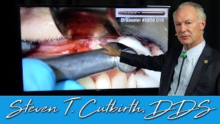 Endodontics amp Apicoectomy on a Lateral Incisor  Dental Minute with Steven T Cutbirth DDS [upl. by Llerral]