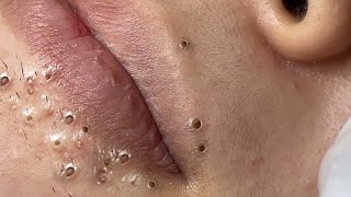 Big Cystic Acne Blackheads Extraction Blackheads amp Milia Whiteheads Removal Pimple Popping  3590 [upl. by Laucsap149]