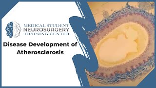 Disease Development of Atherosclerosis [upl. by Sandler]