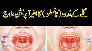 Homeopathic Treatment For Tonsils By Dr Naveed  Tonsil Ka Gharelu ilaj [upl. by Simeon]