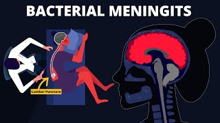 Bacterial Meningitis  Symptoms Diagnosis Treatments amp Pathology [upl. by Fatima]