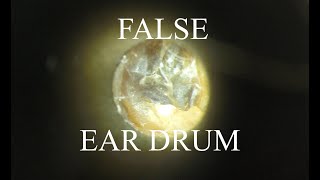 FALSE EAR DRUM  HEARING LOSS  4KHD [upl. by Forsyth47]