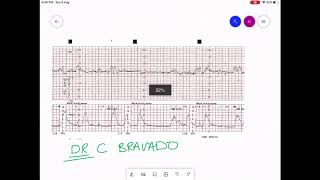 CARDIOTOCOGRAPHY  CTG INTERPRETATION [upl. by Smukler]