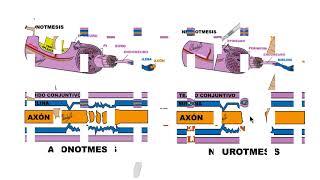 NEUROPRAXIA  AXONOTMESIS  NEUROTMESIS [upl. by Netti]