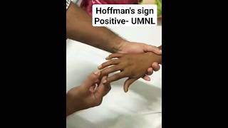 Hoffmans Sign Babinski of Upper Limb mbbs [upl. by Ayanet]