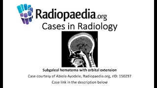 Subgaleal hematoma with orbital extension Radiopaediaorg Cases in Radiology [upl. by Theis687]