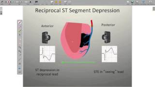 Localizing Ischemia on the ECG [upl. by Lamson]