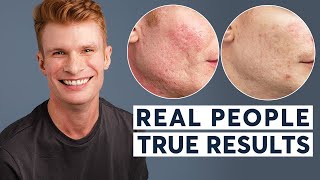 Acne Scar Removal  Real People True Results [upl. by Yeliah801]