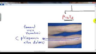 GENERAL PATHOLOGY 40  hyperaemia and oedema DR SAMEH GHAZY [upl. by Aillij]