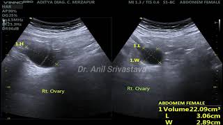 MUCINOUS CYSTADENOMA OVARY [upl. by Notsreik]