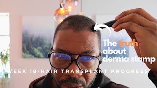 Week 18   month 4  Turkey Hair transplant The derma stamp [upl. by Illoh]