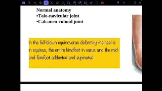 Congenital talipes equinovarus part 1 [upl. by Adla805]