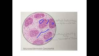 Mucoepidermoid carcinoma [upl. by Franza]