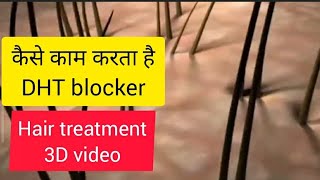 DHT blocker in 3D  Dr Telang MD [upl. by Lilaj]