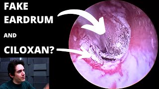 Fake Eardrum And Medication Residue Suction Ciloxan Or Cilodex [upl. by Naejarual390]