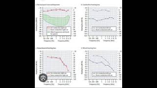 Audiogram Interpretation [upl. by Ativ]