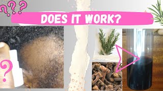 😮I used rosemary and cloves water on my bald spot and this happened [upl. by Ayotahc714]