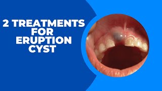 2 Treatments For Eruption Cyst Recommended by Dentists [upl. by Uzial]