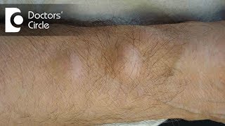 Does painful lump present on body indicate Lipoma  Dr Nanda Rajaneesh [upl. by Sefton]