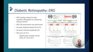 RETeval Case Study DR Score Helps Overcome Blind Faith in Weight Loss Drug Jeff Calhoun OD FAAO [upl. by Jolenta]