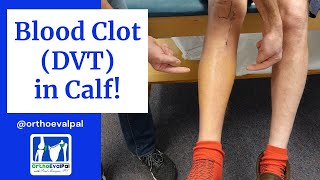 Blood Clot DVT in the Calf Actual Patient Presentation [upl. by Crompton536]