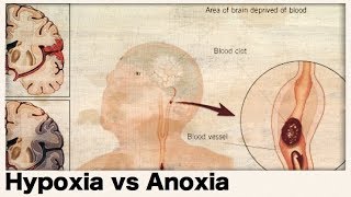 What is the difference between hypoxia and anoxia [upl. by Elka146]