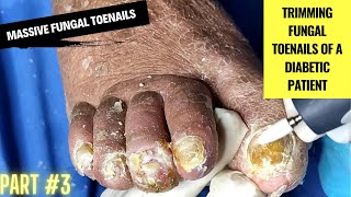 Massive Fungal Toenails  Trimming Fungal Toenails of a Diabetic Patient  Part 3 Podiatry [upl. by Htenaj]