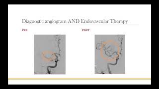 AANS Coding Shorts Middle Cerebral Artery Thrombectomy [upl. by Afas258]