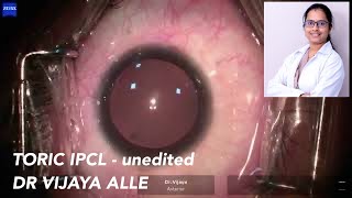 A video of TORIC IPCL  Dr Vijaya Alle [upl. by Myk]