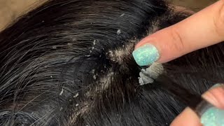 Picking and combing through dandruff psoriasis scalp scratching flare up [upl. by Aihtibat221]