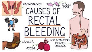 Understanding the Causes of Blood in Stool Rectal Bleeding [upl. by Marv]