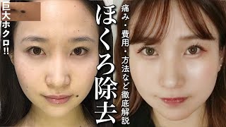 【巨大】ホクロ除去について費用・方法・痛みを徹底解説。施術の様子や経過もお見せします。【自己肯定感シリーズ】 [upl. by Gilboa5]