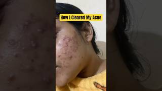 My Skin Transformation Journey Cleared Acne  Acne Treatment  Acne Journey  Pimples treatment [upl. by Ajiram619]